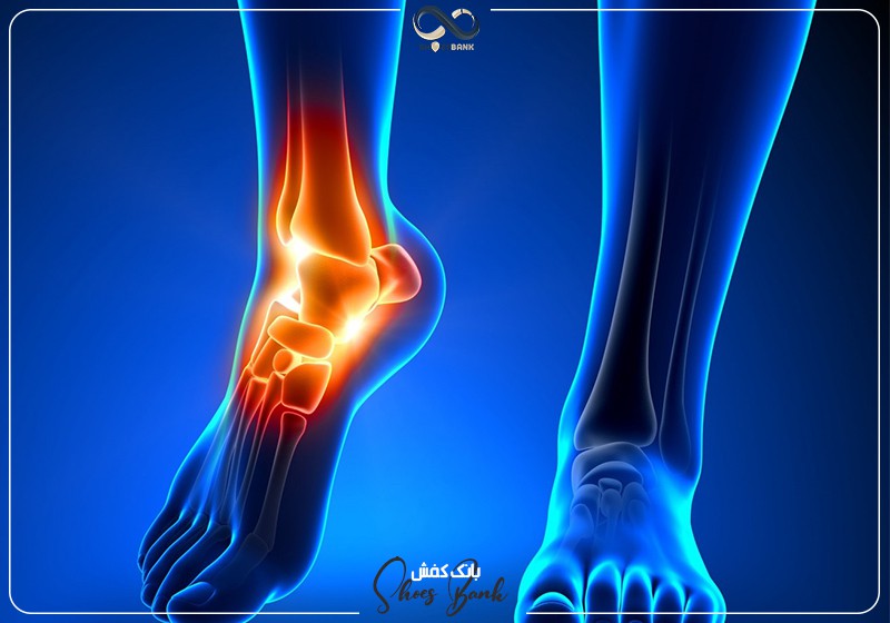 آرتروز